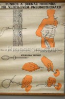 School poster - Puncture and drainage