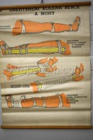 School poster - Immobilization of the knee